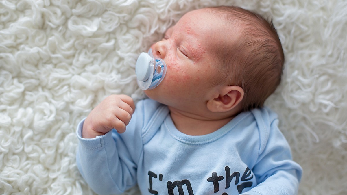acne niños no les molesta. Bebé durmiendo con chupete azul